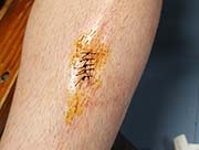 sutura corte en la tibia